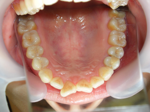 前歯2本の前突が気になる症例4　術前
