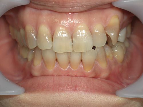 薬物により先天的に歯に色がついてしまった症例　術前
