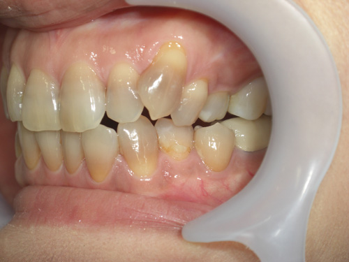 薬物により先天的に歯に色がついてしまった症例2　術前