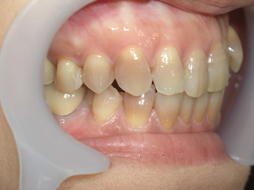 薬物により先天的に歯に色がついてしまった症例3　術前