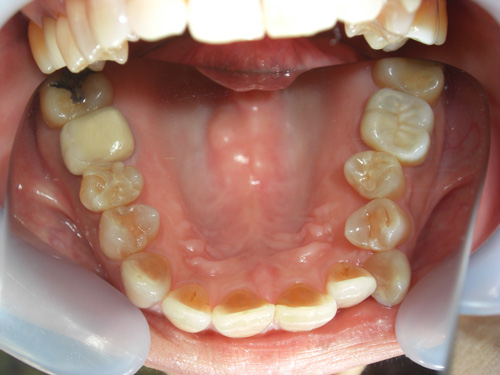 薬物により先天的に歯に色がついてしまった症例4　術前