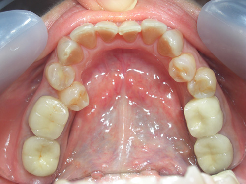 薬物により先天的に歯に色がついてしまった症例5　術前