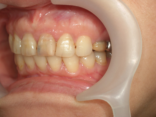 前歯がつぎはぎになっている症例　術前2