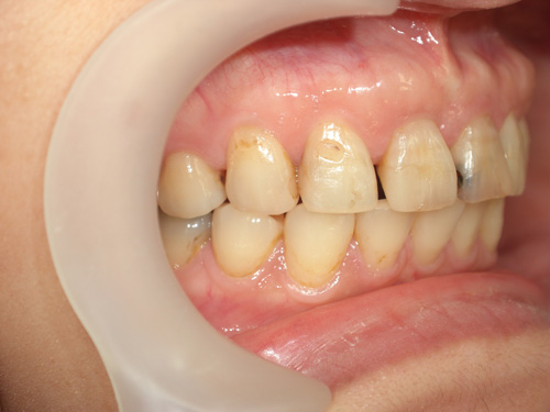 前歯がつぎはぎになっている症例　術前3