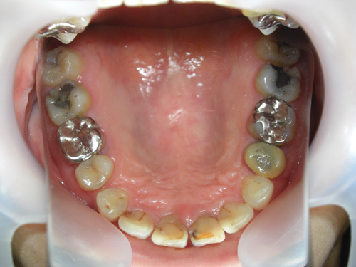前歯がつぎはぎになっている症例　術前4