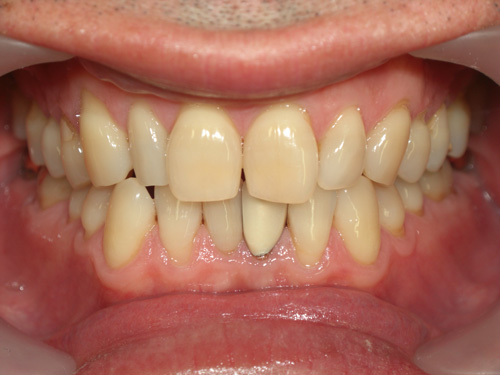 前歯の色を白くして金属の歯を白くした症例　術前
