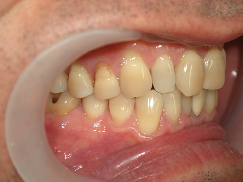 前歯の色を白くして金属の歯を白くした症例2　術前