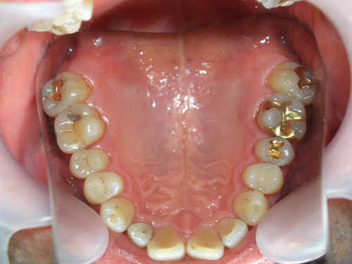 前歯の色を白くして金属の歯を白くした症例3　術前