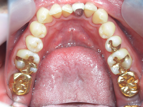 前歯の色を白くして金属の歯を白くした症例4　術前