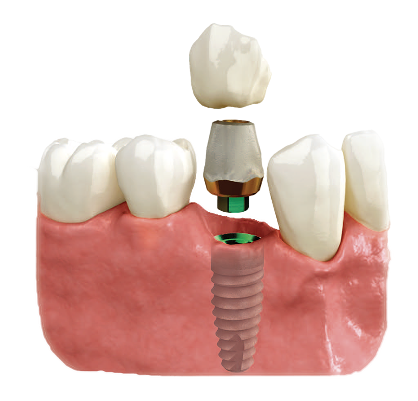 歯科用インプラントによる歯科治療