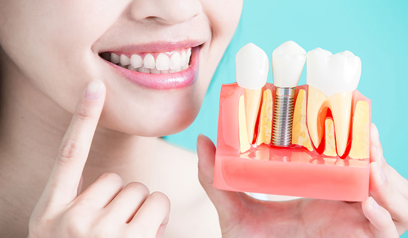 歯科用インプラントとかみ合わせの関係性