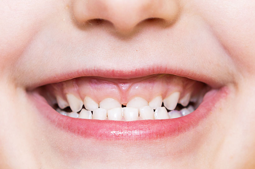 歯並びを整え、発音への影響を最小化する小帯の処置