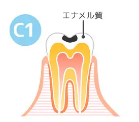 軽度の虫歯（C1）