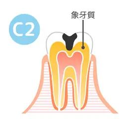 中度の虫歯（C2）