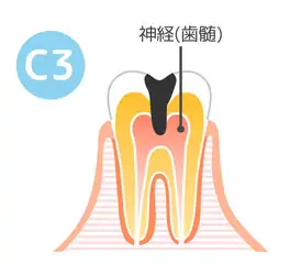 重度の虫歯（C3）
