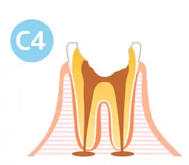 歯の崩壊（C4）