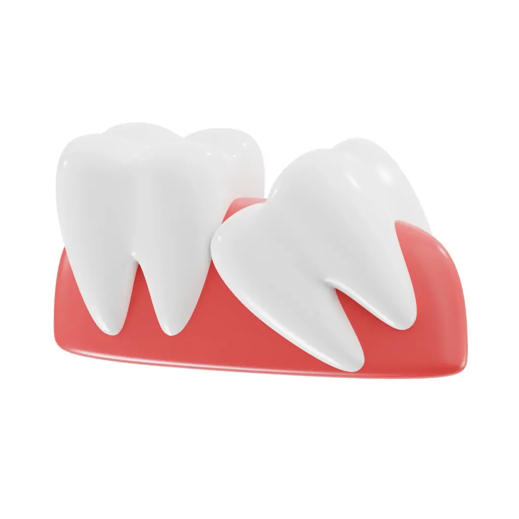 親知らずの抜歯について